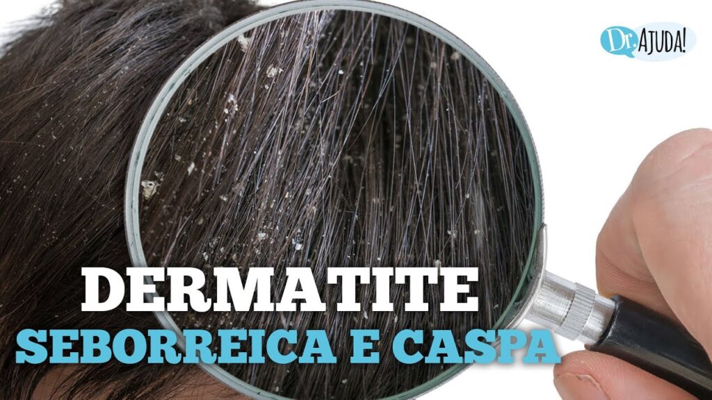 dermatite_seborreica-1024x576 Dermatite seborreica: Quais são as causas? O que fazer?