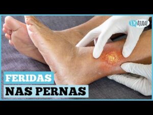 Feridas-nas-pernas-300x225 Vai Vendo Brasil Portal de Notícias
