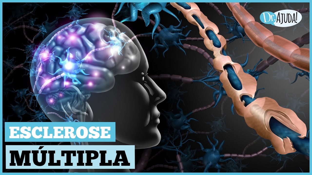 O que é esclerose múltipla? Quais os sintomas e o tratamento?